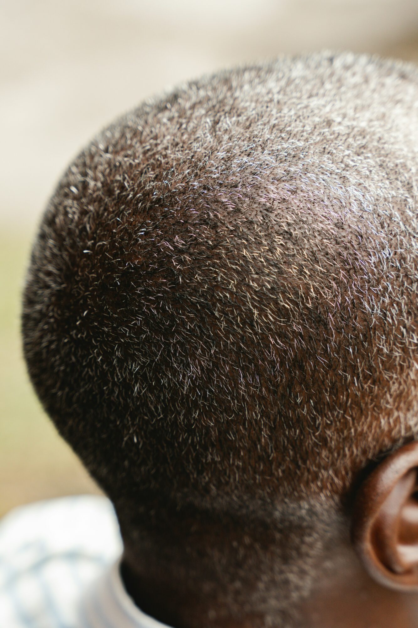 le PRP cheveux dans le traitement de la pelade et du psoriasis du cuir chevelu Clinique Rivoli Massena 2